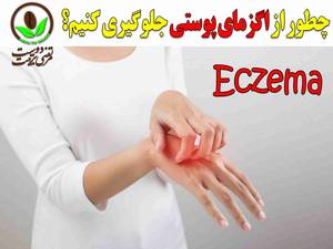 چطور از اگزمای پوستی جلوگیری کنیم ؟