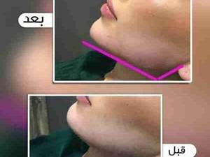 جراحی زیبایی فک و صورت در یزد