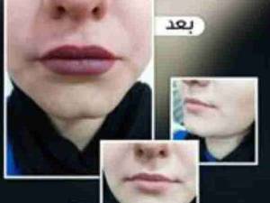 تزریق بوتاکس وچربی دریزد