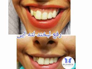 رفع لبخند لثه ایی