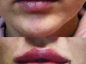 میکس روغن خراطین و زالو برای حجم دهی لب ها