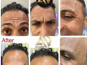 بوتاکس در کلینیک آریادرم