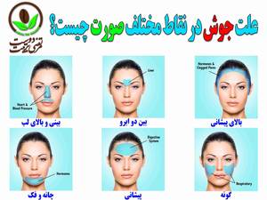 علت جوش در نقاط مختلف صورت چیست ؟