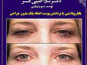 بلفاروپلاستی یا برداشتن پوست اضافه پلک بدون جراحی