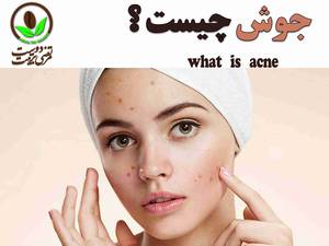 جوش چیست ؟