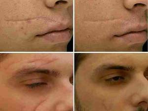 ترمیم و از بین بردن جای اسکار زخم و بخیه از صورت