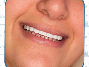 رفع دیاستم دندانی