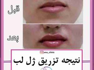 تزریق ژل لب