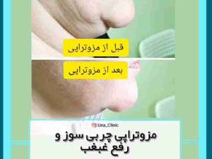 مزوتراپی چربی سوز و رفع غبغب
