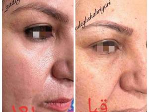 جوانسازی پوست با لیزر ترکیبی