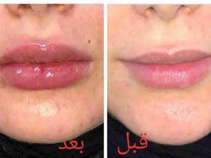 تزریق ژل لب
