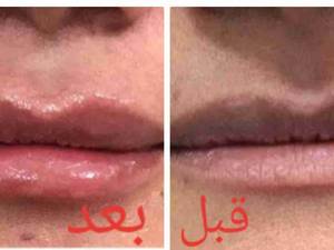 تزریق ژل لب