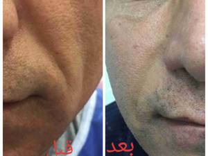تزریق چربی