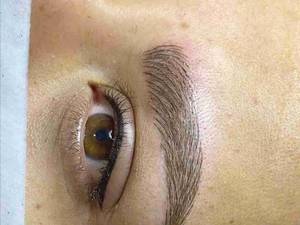 میکروبلیدینگ به سبک فیبروز