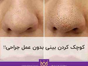 کوچک کردن بینی بدون عمل جراحی