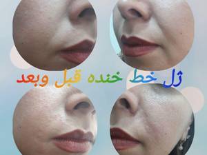 ژل خط خنده قبل و بعد