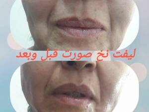لیفت نخ صورت قبل و بعد