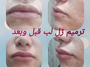 ترمیم ژل لب قبل و بعد