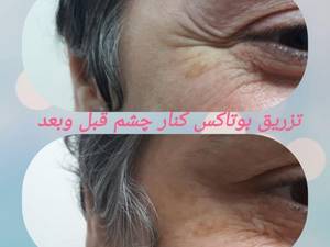 تزریق بوتاکس کنار چشم