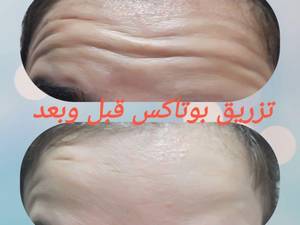 تزریق بوتاکس