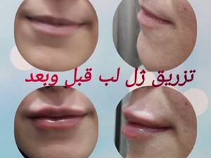 تزریق ژل لب