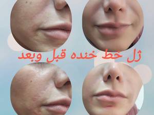 ژل خط خنده