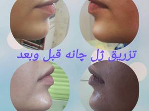 تزریق ژل چانه