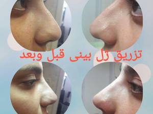 تزریق ژل بینی