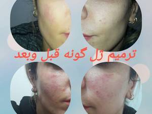 ترمیم ژل گونه