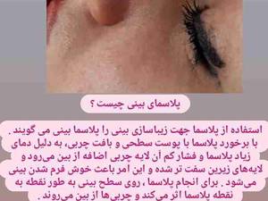 پلاسما بینی