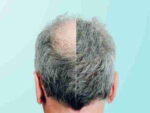کلیه خدمات کلینیک کاشت موی گیلان فیت