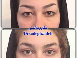 بلفاروپلاستی