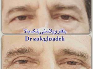 بلفاروپلاستی