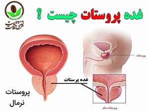 غده پروستات چیست ؟