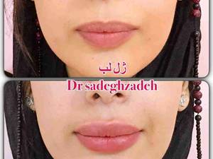 تزریق ژل لب