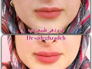 تزریق ژل لب