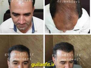 کلینیک کاشت مو گیلان فیت در رشت
