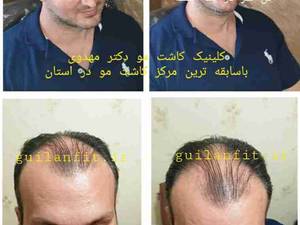 کلینیک کاشت موی گیلان فیت __ دکتر مهدوی به روش غیرجراحی سوپر sut