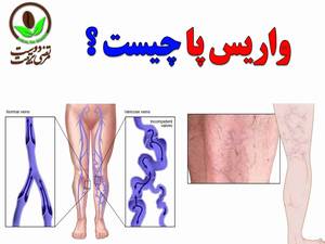 واریس پا چیست ؟