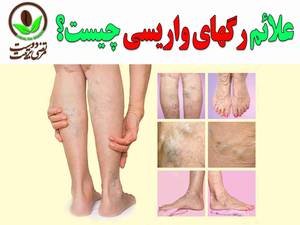 علائم رگهای واریسی چیست؟