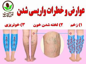 عوارض و خطرات واریسی شدن رگها چیست؟