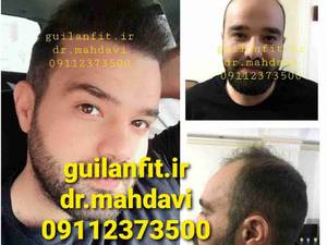 کلینیک کاشت مو گیلان فیت دکتر مهدوی دررشت