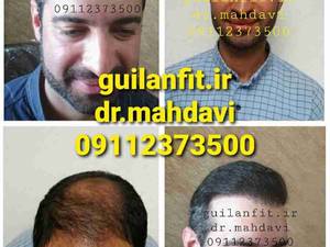 کاشت موی گیلان فیت دکتر مهدوی