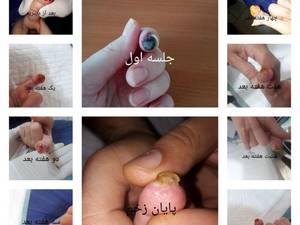 زخم دیابت