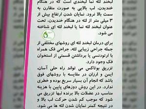 درمان لبخند لثه ای با بوتاکس