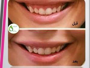 درمان لبخند لثه ای با بوتاکس