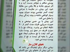 جوانسازی با نخ در رشت گلسار