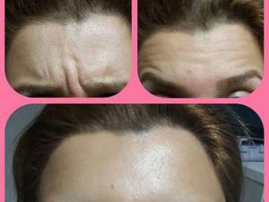 بوتاکس پیشانی بدون تغییر حالت ابرو