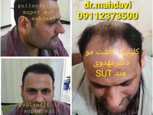 کلینیک کاشت مو گیلان فیت در رشت  دکترمهدوی