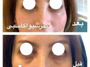 انجام فیلر زیر چشم